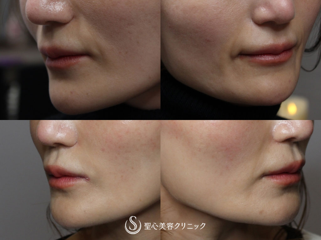 【40代の女性・気になるほうれい線を改善】プレミアムPRP皮膚再生療法（半年後） After 