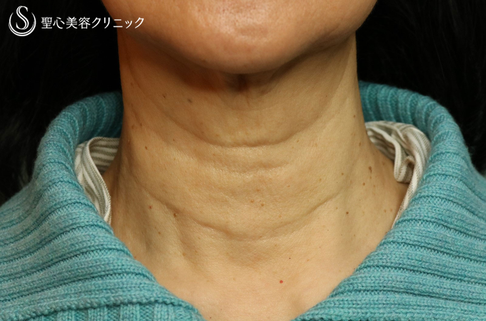 【60代女性：気になる首の横ジワを改善】プレミアムPRP皮膚再生療法（3ヶ月後） Before 