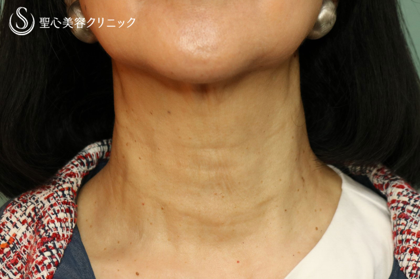 【60代女性：気になる首の横ジワを改善】プレミアムPRP皮膚再生療法（3ヶ月後） After 