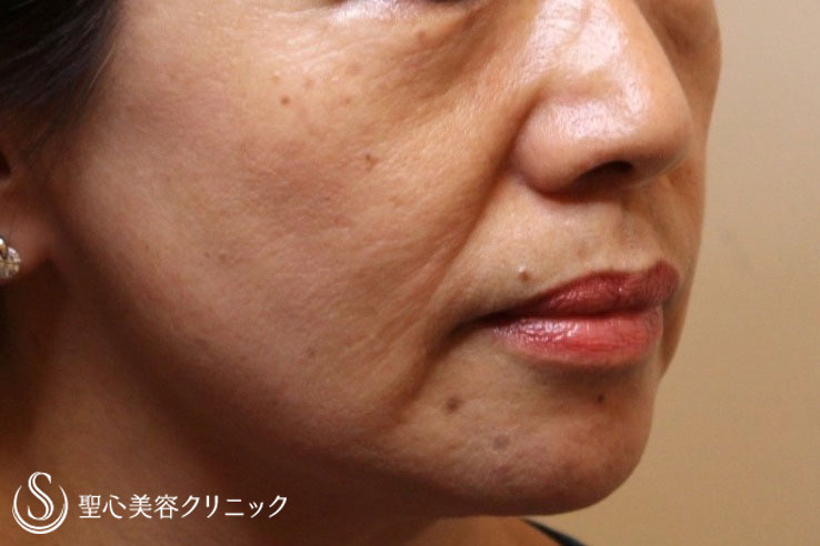 【60代女性・目の下や顔のたるみを長期的に改善】プレミアムPRP、ドクターハイフ（ウルセラシステム）2回後（9年後） Before 
