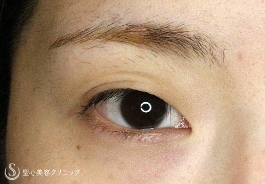 【20代女性・華やかな平行型の二重】二重全切開+α法（7ヶ月後）札幌院 Before 