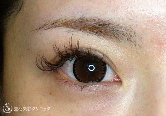 【20代女性・華やかな平行型の二重】二重全切開+α法（7ヶ月後）札幌院 After 