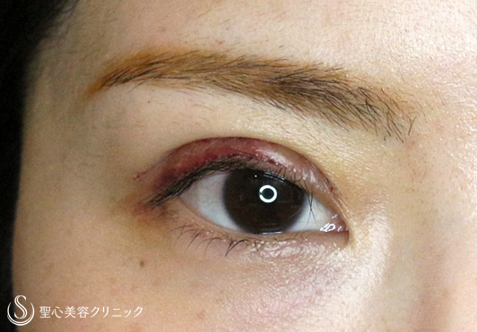 【20代女性・華やかな平行型の二重】二重全切開+α法（7ヶ月後）札幌院 After 