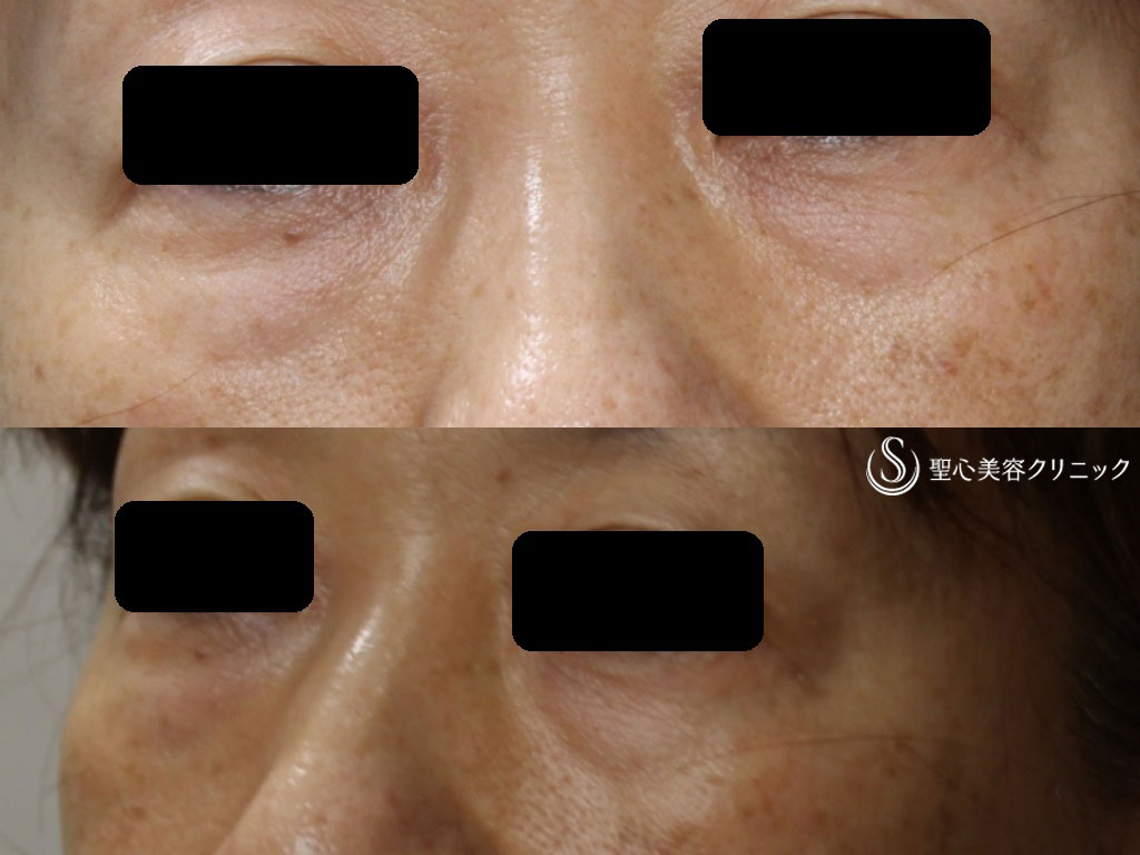 【50代女性・目の下のたるみ、ふくらみの治療】PRP皮膚再生療法（9ヶ月後） Before 