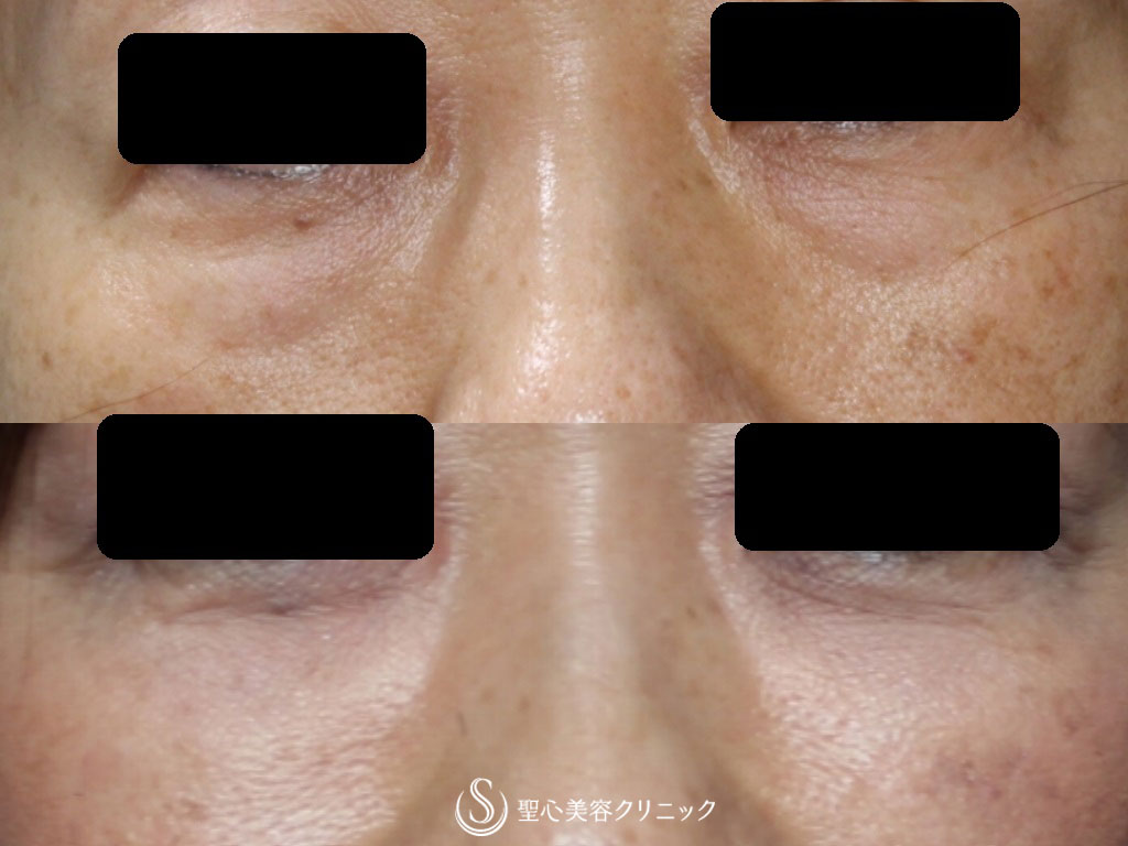 【50代女性・目の下のたるみ、ふくらみの治療】PRP皮膚再生療法（9ヶ月後） After 
