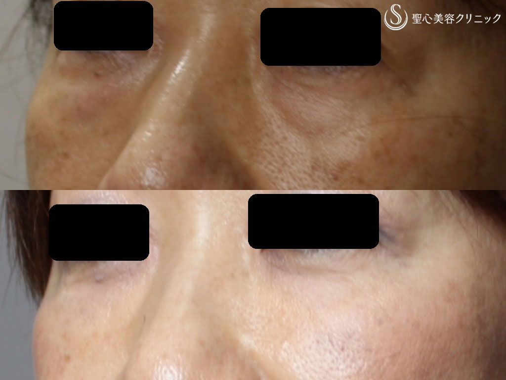 【50代女性・目の下のたるみ、ふくらみの治療】PRP皮膚再生療法（9ヶ月後） After 