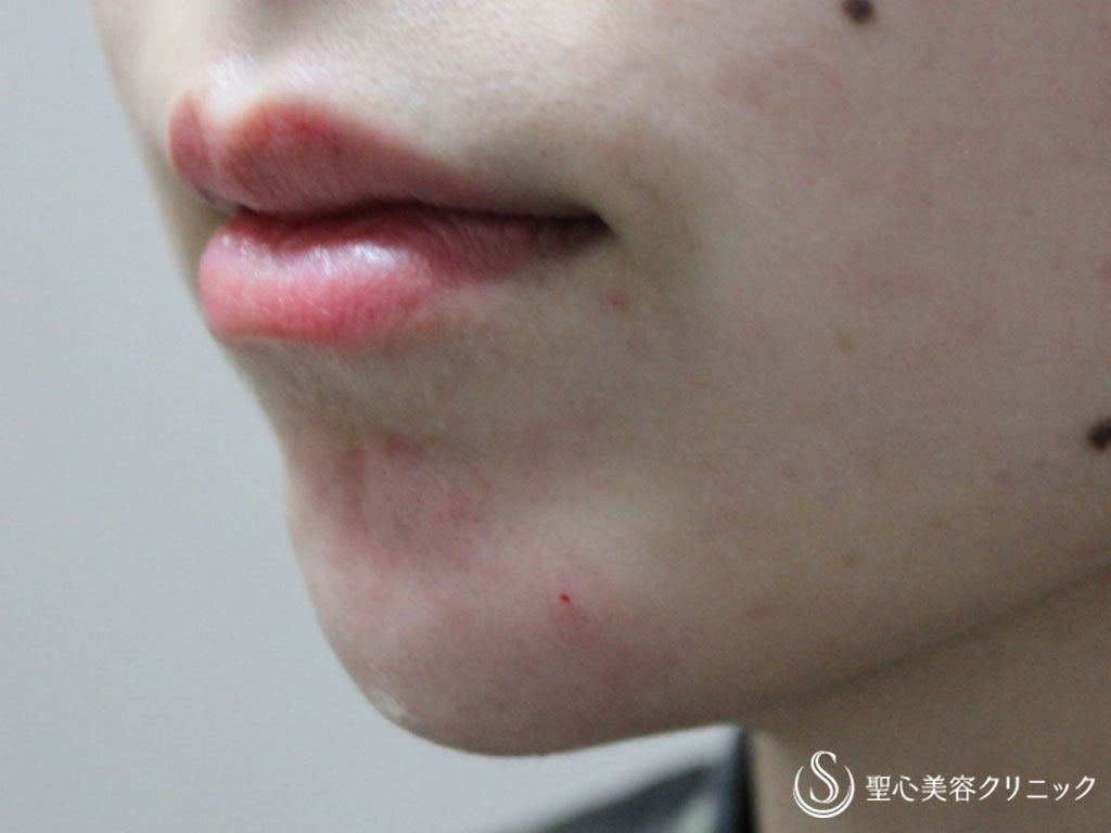 30代女性・定期的な追加注入でより顎の形を整える】顎のクレヴィエル 