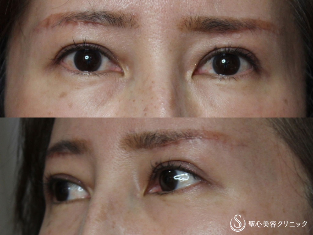 40代女性 まぶたのたるみを改善 眉下切開 リフト 1ヶ月後 症例写真 美容整形 美容外科なら聖心美容クリニック