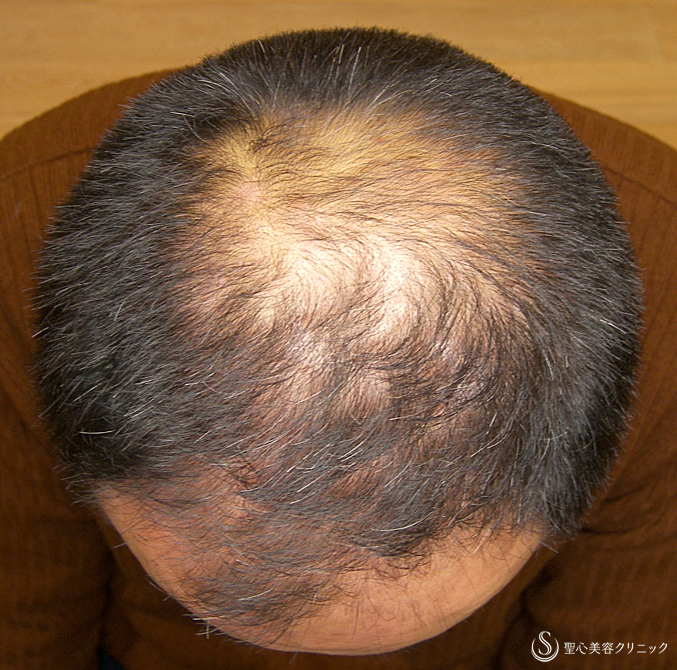 【40代男性・AGA脱毛】プレミアム・グロースファクター毛髪再生療法（6回後）札幌院 Before 