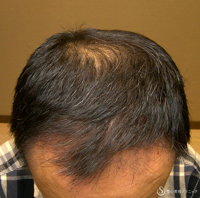【40代男性・AGA脱毛】プレミアム・グロースファクター毛髪再生療法（6回後）札幌院 After 