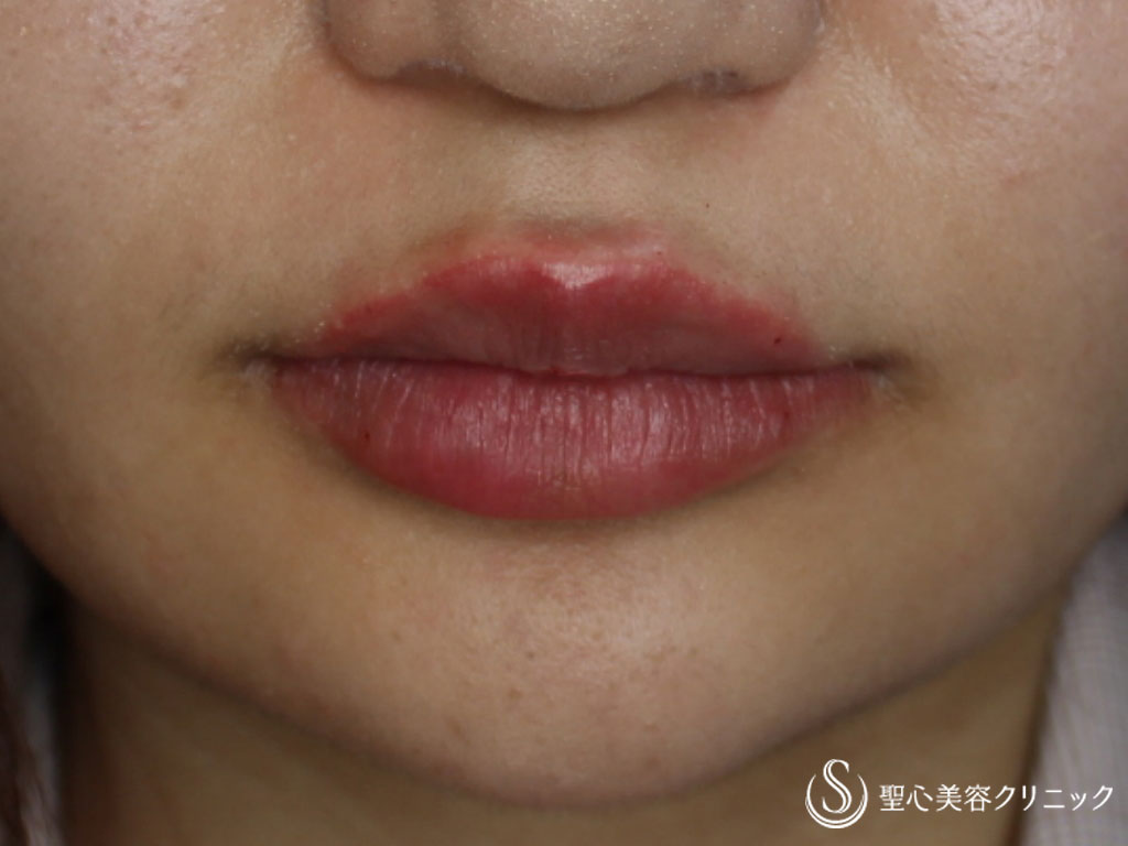 女性 口角の上がった可愛らしいアヒル口に スマイルリップ 症例写真 美容整形 美容外科なら聖心美容クリニック 女性 口角の上がった可愛らしいアヒル口に スマイルリップ 症例写真 美容整形 美容外科なら聖心美容クリニック