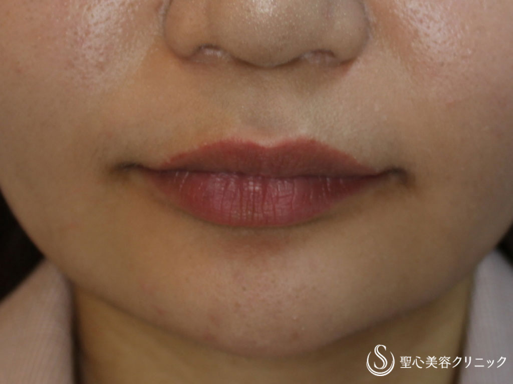 女性 口角の上がった可愛らしいアヒル口に スマイルリップ 症例写真 美容整形 美容外科なら聖心美容クリニック 女性 口角の上がった可愛らしいアヒル口に スマイルリップ 症例写真 美容整形 美容外科なら聖心美容クリニック