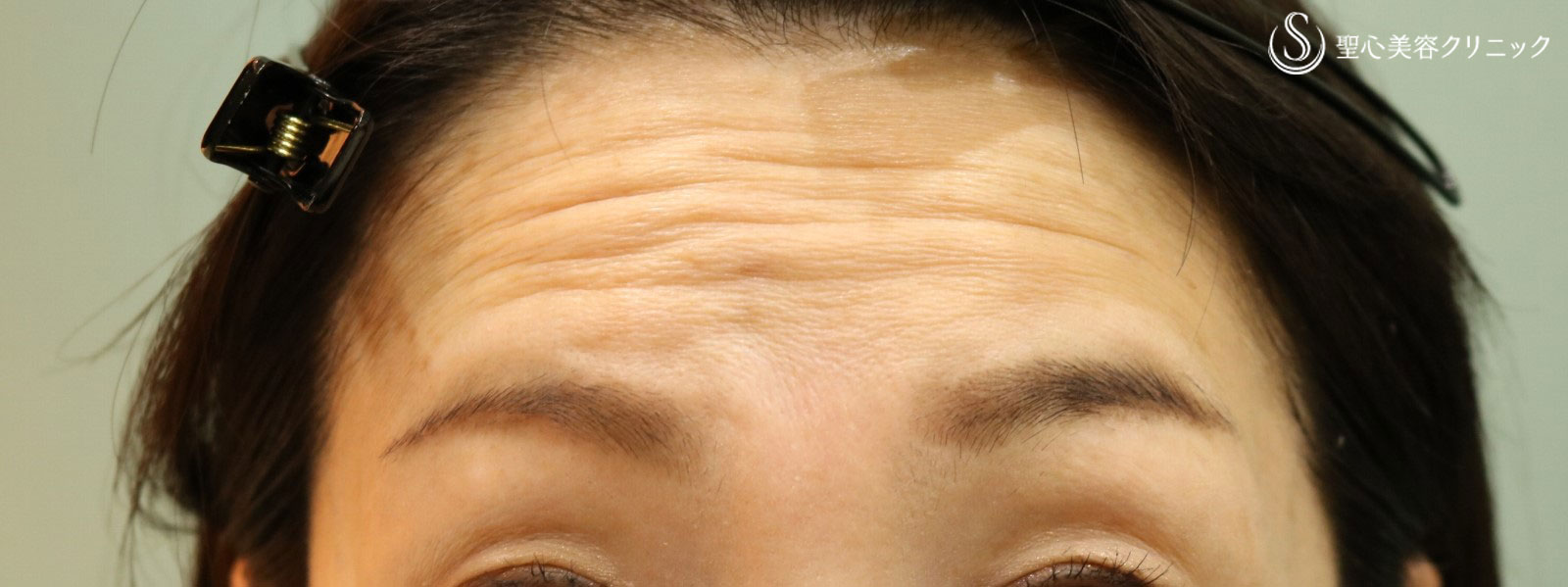 【30代女性・額のしわを改善】プレミアムPRP皮膚再生療法（5ヶ月後） Before 