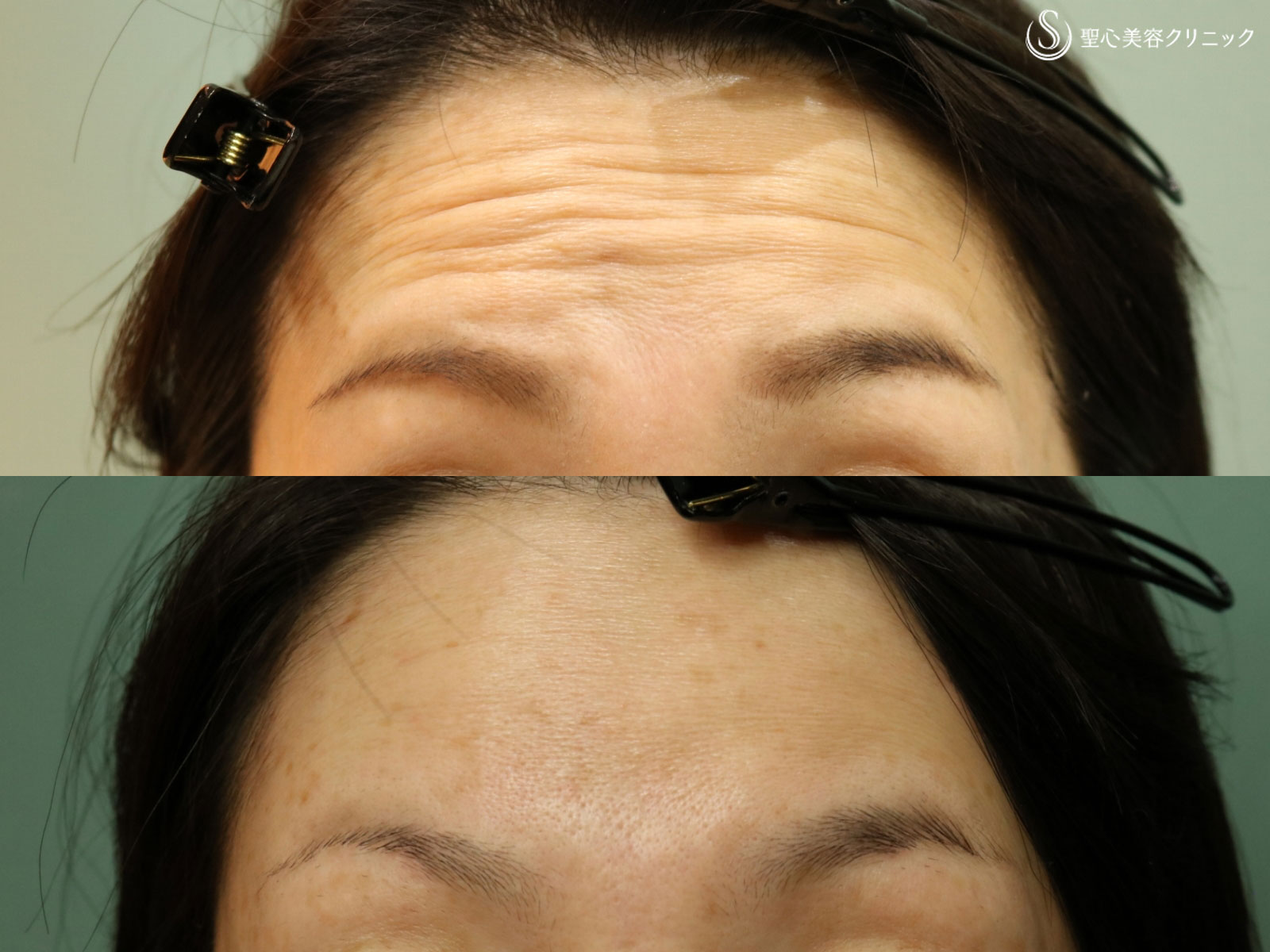 【30代女性・額のしわを改善】プレミアムPRP皮膚再生療法（5ヶ月後） After 