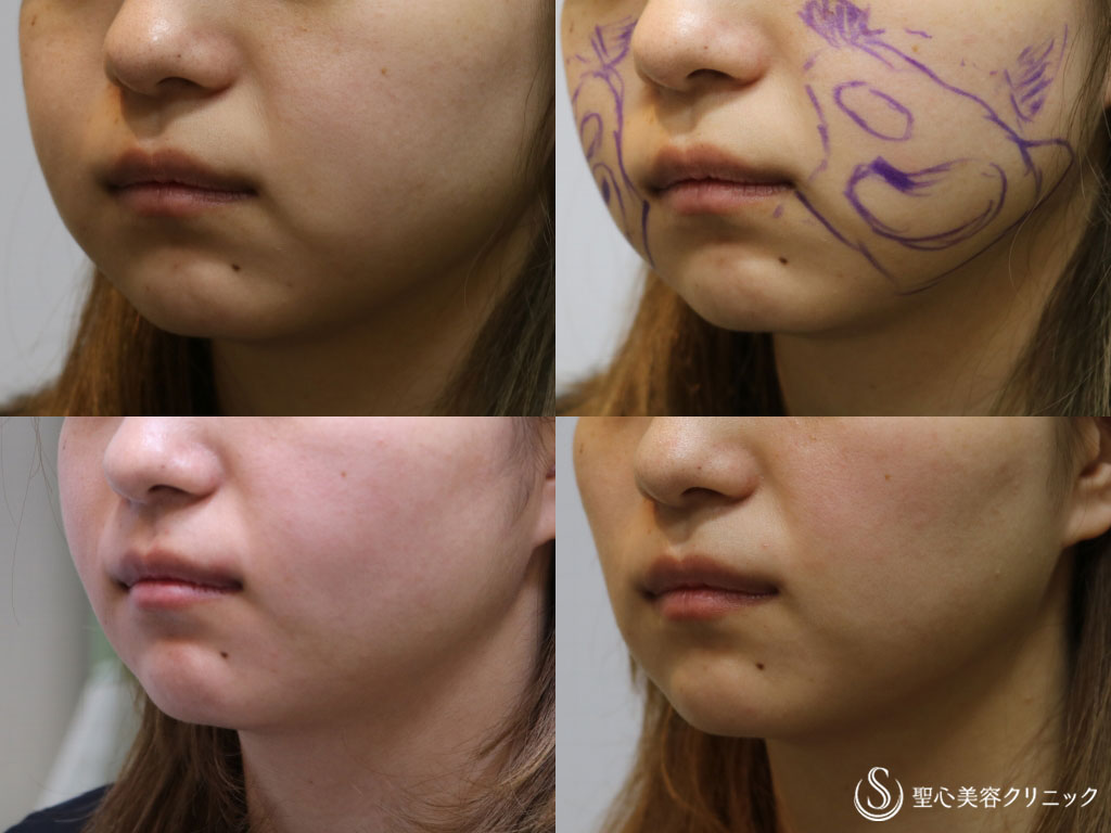 【20代女性・スッキリ小顔に】頬のベイザー脂肪吸引（術後3ヶ月） After 