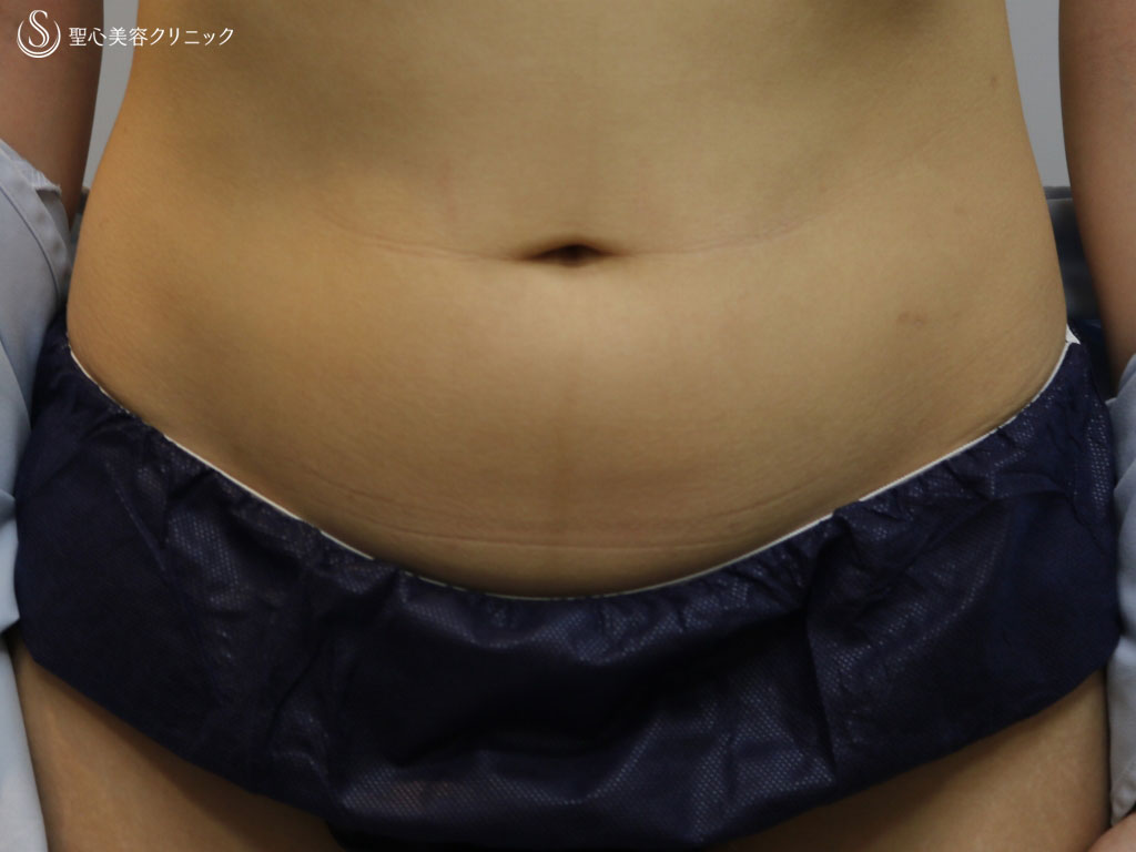 【20代女性・ぽっこり下腹部をスッキリと】ベイザー脂肪吸引（1ヶ月後） Before 