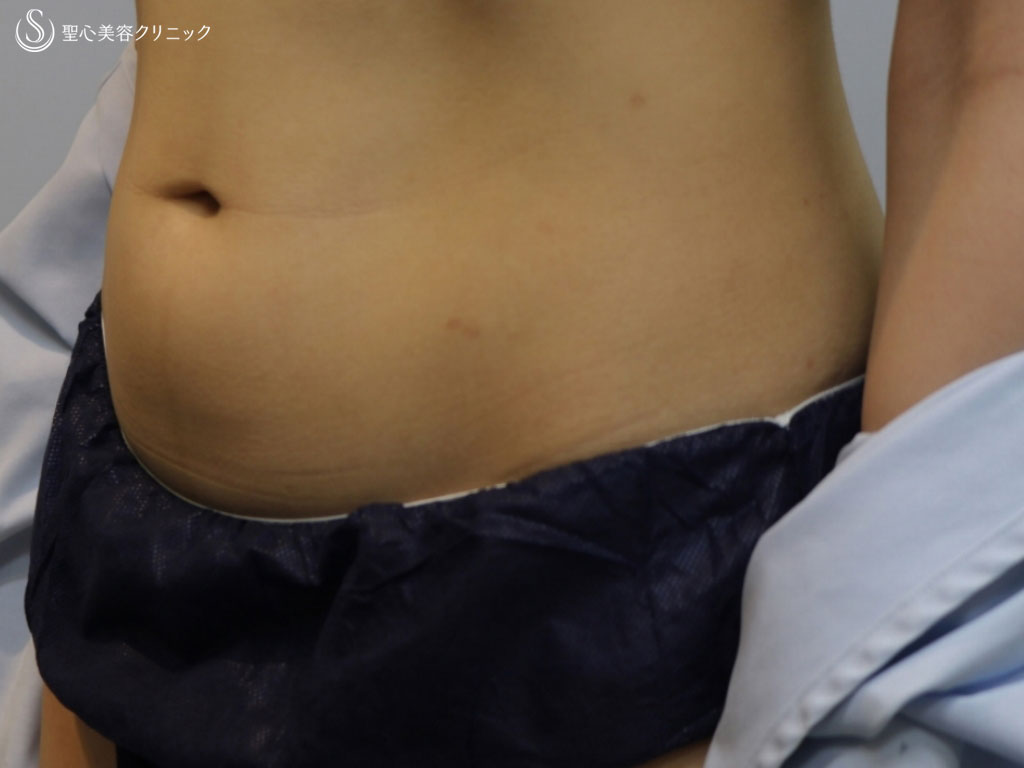 【20代女性・ぽっこり下腹部をスッキリと】ベイザー脂肪吸引（1ヶ月後） Before 