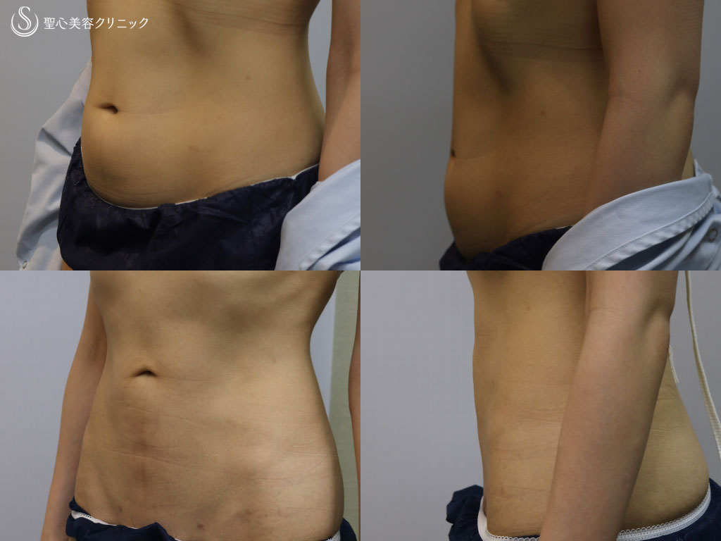 【20代女性・ぽっこり下腹部をスッキリと】ベイザー脂肪吸引（1ヶ月後） After 
