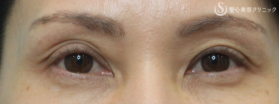 【40代女性・くぼみ目の改善】プレミアムPRP皮膚再生療法（半年後） Before 