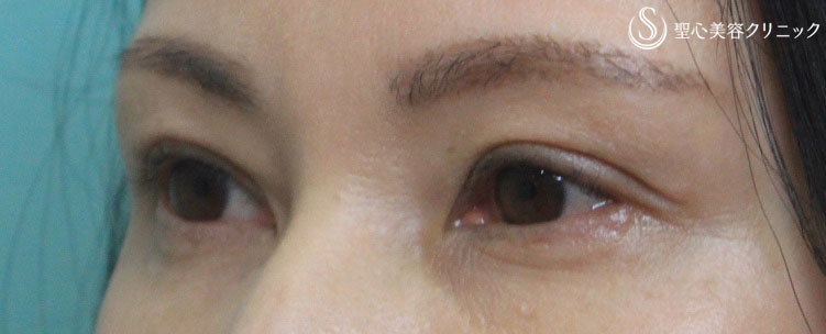 【40代女性・くぼみ目の改善】プレミアムPRP皮膚再生療法（半年後） After 