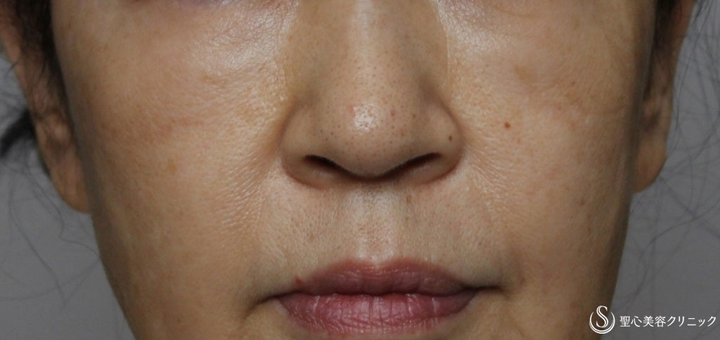 【60代女性・顔の気になる部分の凹みを改善】プレミアムPRP皮膚再生療法（約半年後） After 