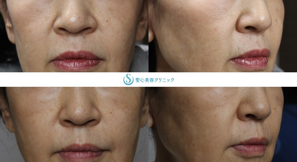【60代女性・顔の気になる部分の凹みを改善】プレミアムPRP皮膚再生療法（約半年後） After 