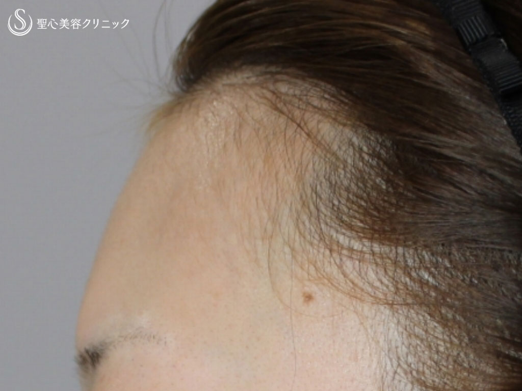 【20代女性・額を理想の形に】額のヒアルロン酸注入（ジュビダームビスタボリューマ）（処置直後） Before 