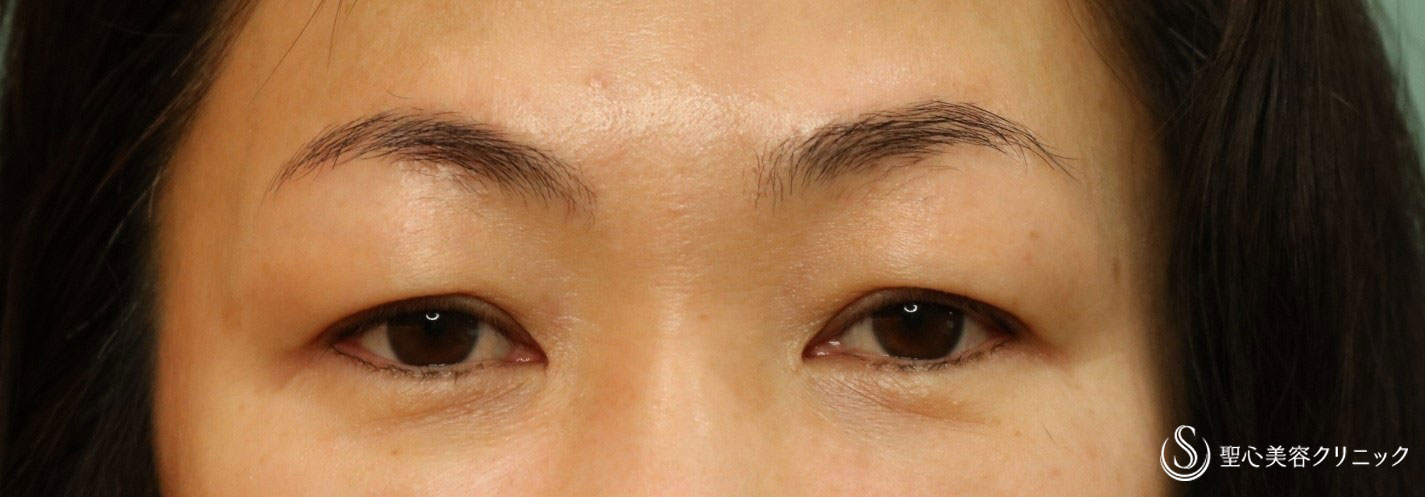 【50代女性・目の上のたるみ、眉の拳上を改善】眉下切開法（3ヶ月後） Before 