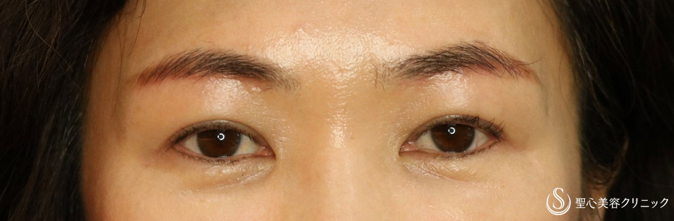 【50代女性・目の上のたるみ、眉の拳上を改善】眉下切開法（3ヶ月後） After 