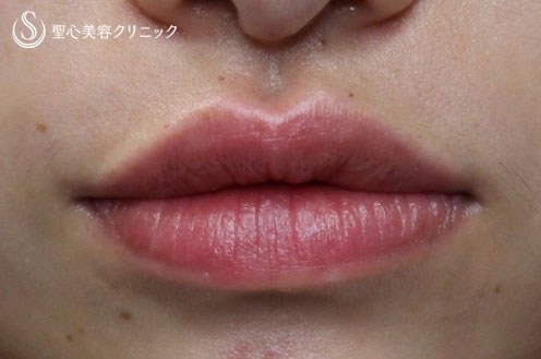 【20代女性・たらこ唇を改善】M字リップと下口唇縮小術（3ヶ月後） Before 