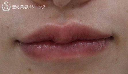 【20代女性・たらこ唇を改善】M字リップと下口唇縮小術（3ヶ月後） After 
