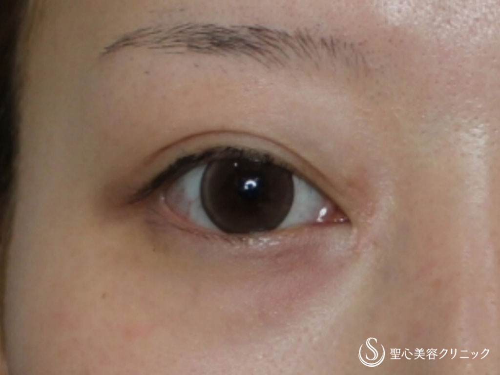 【20代女性・目を大きく綺麗な平行型に】目頭切開（1か月半後） After 