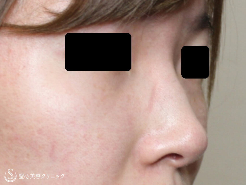 【20代女性・鼻筋が通り理想の鼻に】鼻のプロテーゼ+耳介軟骨移植（１ヶ月後） Before 
