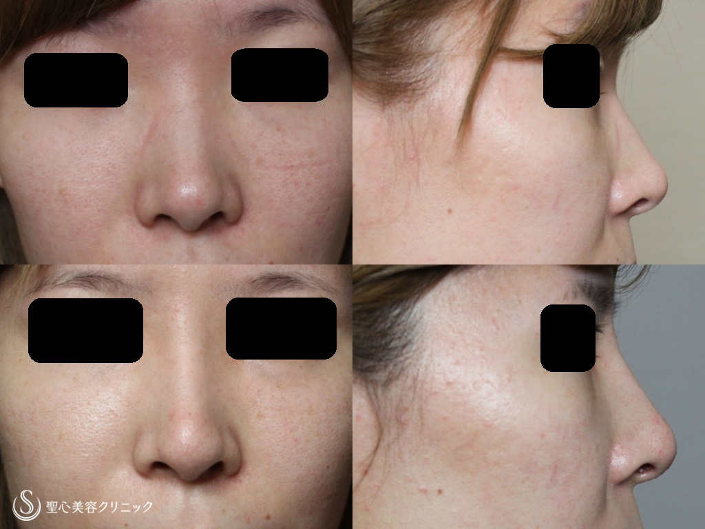 【20代女性・鼻筋が通り理想の鼻に】鼻のプロテーゼ+耳介軟骨移植（１ヶ月後） After 