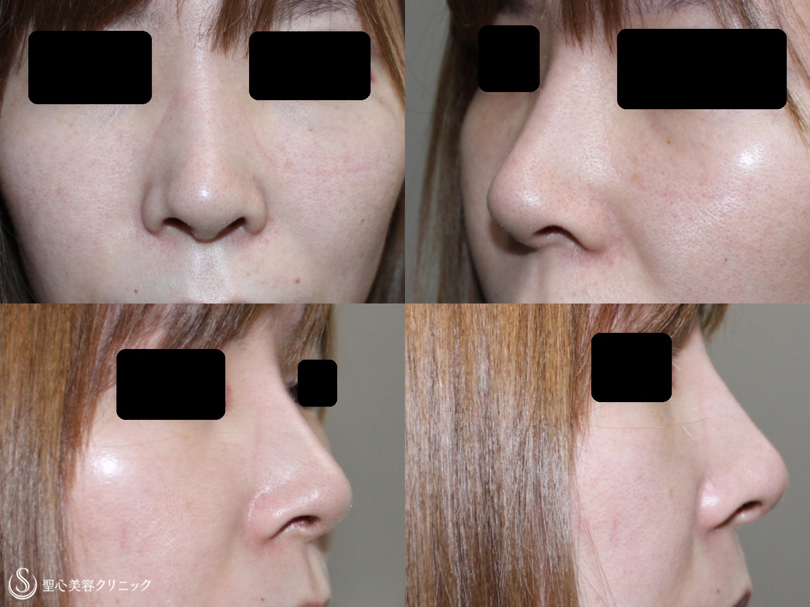 【20代女性・鼻筋が通り理想の鼻に】鼻のプロテーゼ+耳介軟骨移植（１ヶ月後） After 