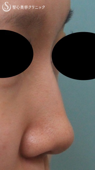 【女性・鼻先の手前の段差を改善】鼻のプロテーゼ Before 