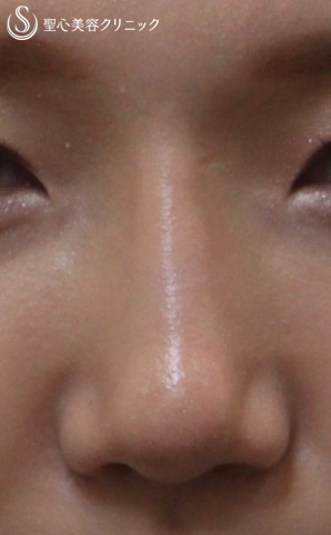 【女性・鼻先の手前の段差を改善】鼻のプロテーゼ After 