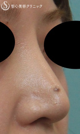 【女性・鼻のプロテーゼを入れ替えて修正】鼻のプロテーゼ入替え+耳介軟骨 After 