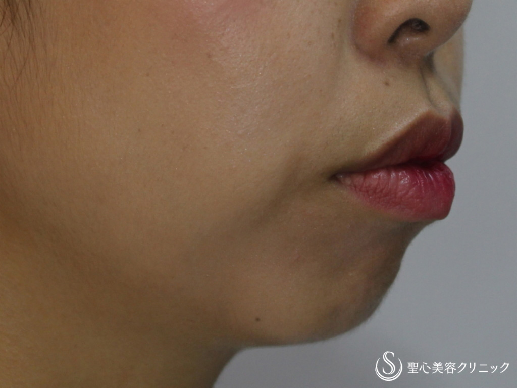 【20代女性・顎のラインと顎先の凸凹を綺麗に】あごのクレヴィエル（ヒアルロン酸）（直後） Before 