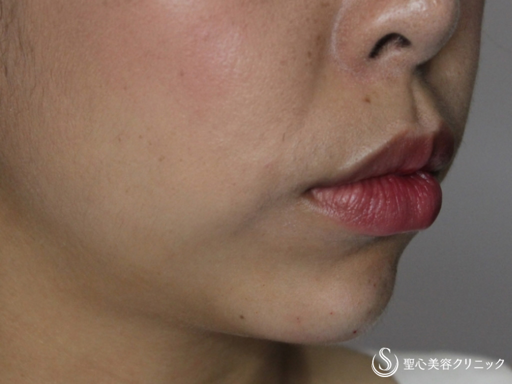 【20代女性・顎のラインと顎先の凸凹を綺麗に】あごのクレヴィエル（ヒアルロン酸）（直後） After 
