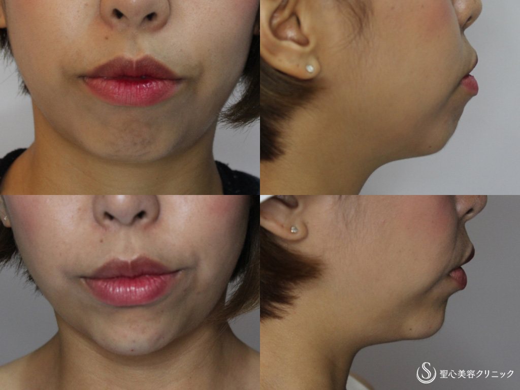 【20代女性・顎のラインと顎先の凸凹を綺麗に】あごのクレヴィエル（ヒアルロン酸）（直後） After 