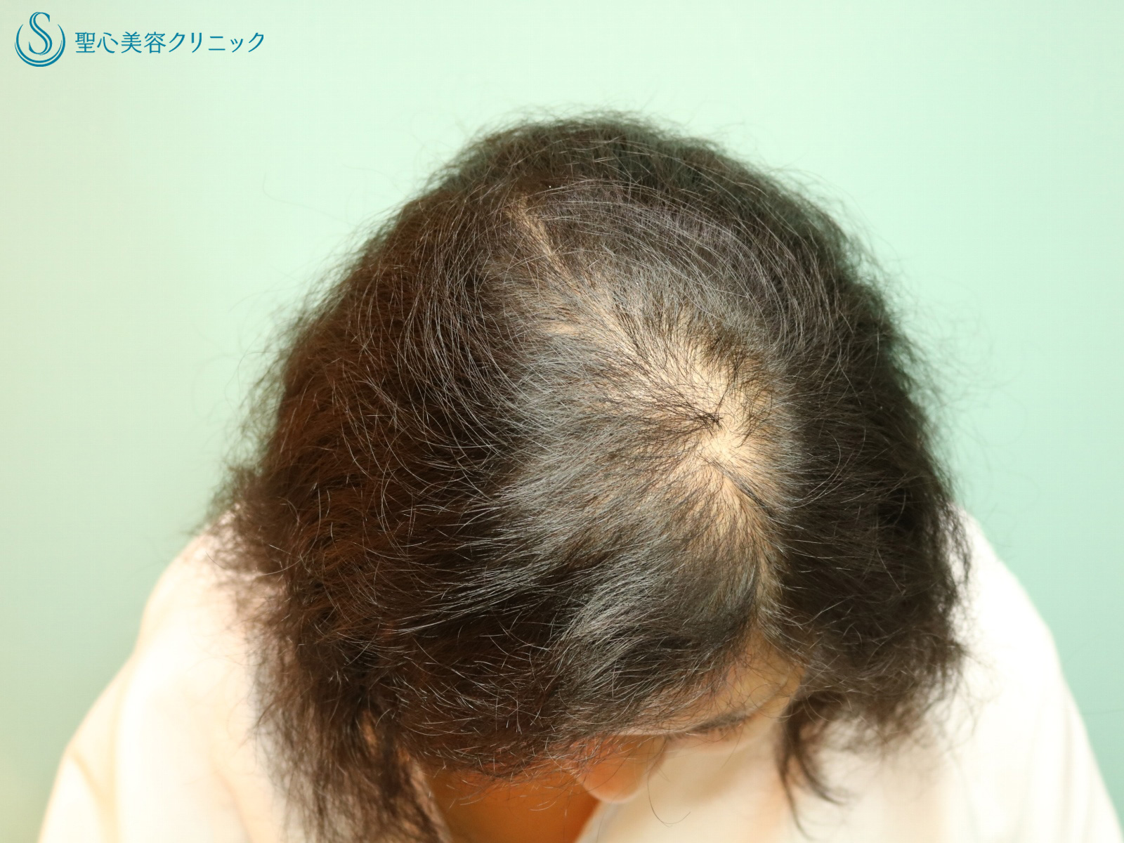 【30代女性・薄毛の改善】ケラステム毛髪再生（1年後） Before 