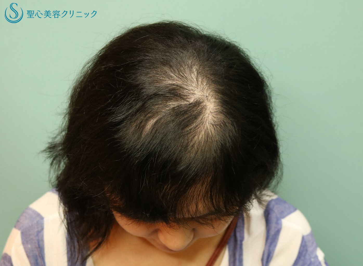 【30代女性・薄毛の改善】ケラステム毛髪再生（1年後） After 