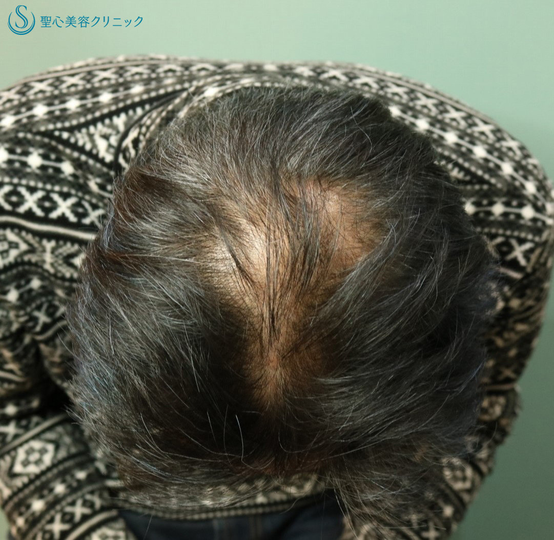 【50代男性・薄毛の改善】プレミアムグロースファクター、アボルブ・ミノキシジル、KIP（再生療法12回後） Before 