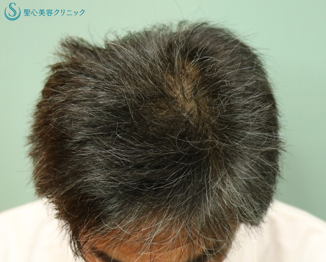 【50代男性・薄毛の改善】プレミアムグロースファクター、アボルブ・ミノキシジル、KIP（再生療法12回後） After 
