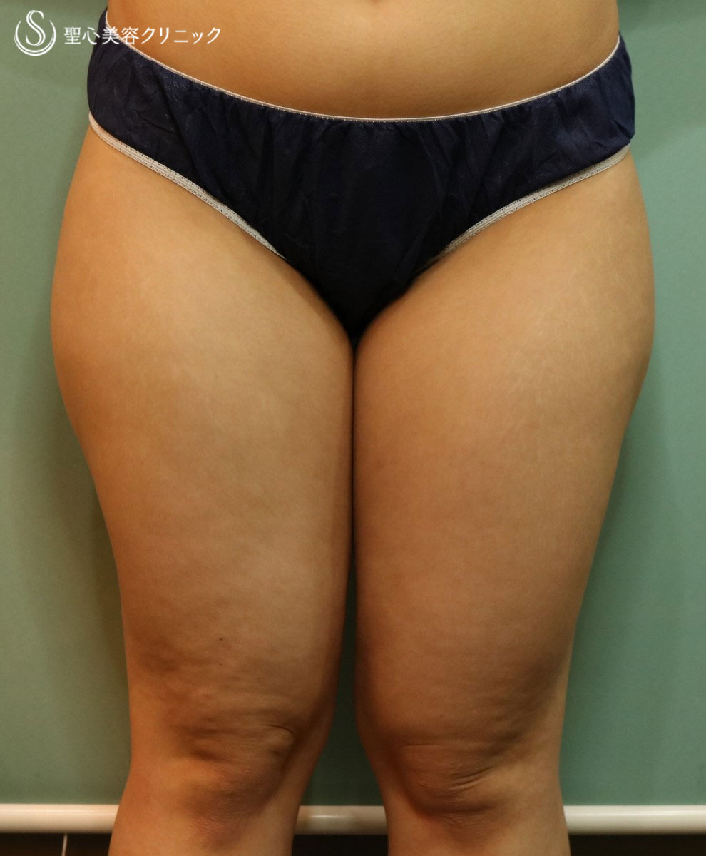代女性 太ももを細くセルライトも改善 ベイザーリポ2 2 脂肪吸引 １ヶ月後 症例写真 美容整形 美容外科なら聖心美容クリニック