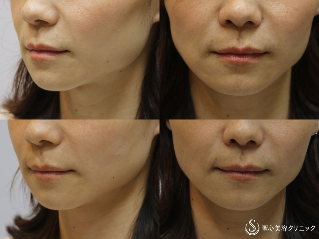 【30代女性・頬の凹みをなくし疲れた印象を改善】頬のヒアルロン酸注入（直後） After 