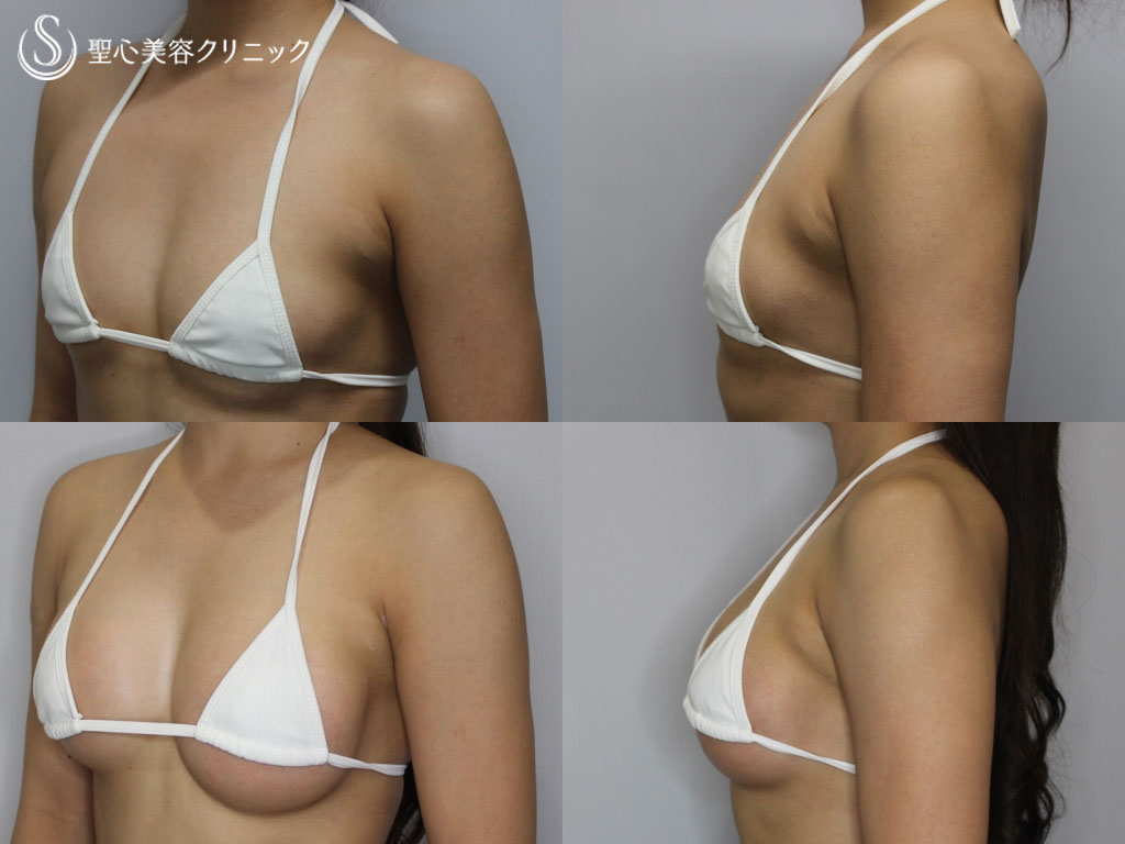 【20代女性・バストアップ】豊胸術（モティバエルゴノミクス）（1ヶ月後） After 