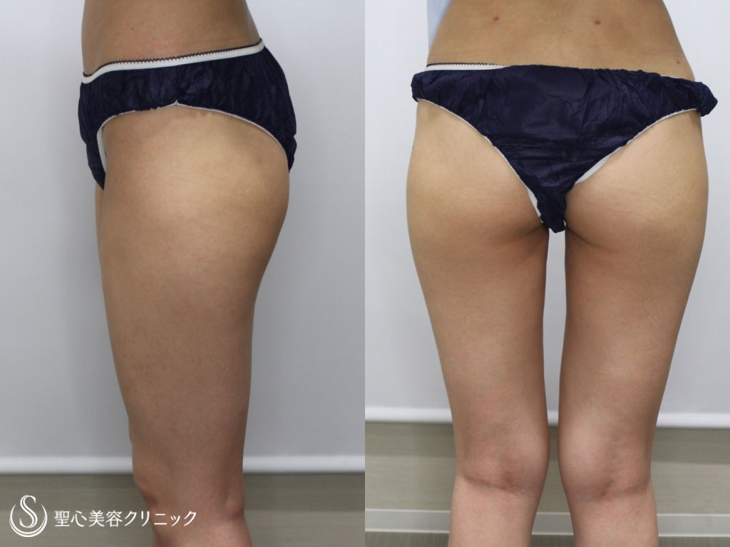 【30代女性・下半身の気になる部分をスリムに】ベイザー脂肪吸引（臀部外～腰下、太もも前面）（3ヶ月後） After 