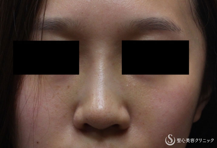 【20代女性・鼻を自然に高く】プロテーゼ+耳介軟骨（1ヶ月後） After 